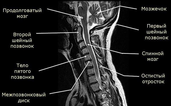 Защемление шейного нерва симптомы. Шейный радикулит. Радикулит шейного отдела. Радикулит шейного позвонка. Шейный радикулит 7 позвонок.