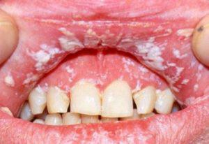 Кандидоз в ротовой полости: симптомы грибка во рту у взрослых, лечение белого налета препаратами и диетой