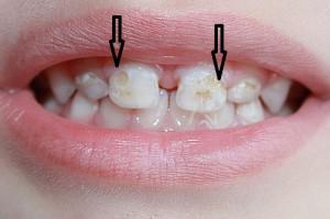 Почему у ребенка в 1-2 года разрушаются молочные зубы и крошится эмаль, что делать?