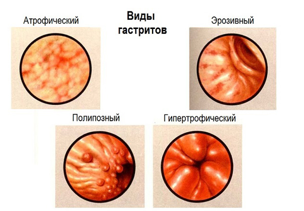 Виды гастритов