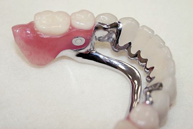 Бюгельный протез зубной на нижнюю челюсть фото