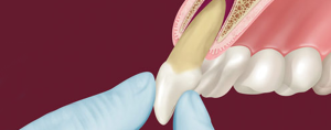 Особенности реплантации зубов, показания и противопоказания к процедуре, этапы операции
