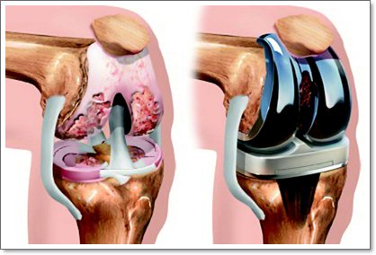 Состояние на фоне эндопротезирования суставов