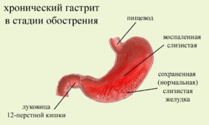 Обострения гастрита