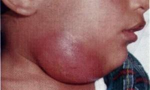 История болезни абсцесс челюстно язычного желобка thumbnail