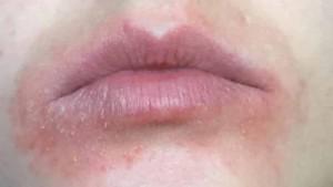 Чем лечить ожоги на губе: симптомы, первая помощь и общая тактика терапии