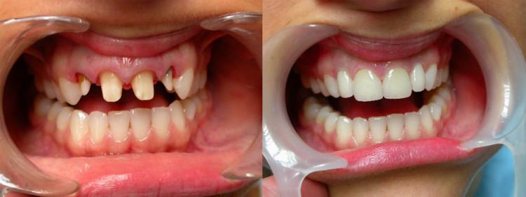 Зубы до и после протезирования фото