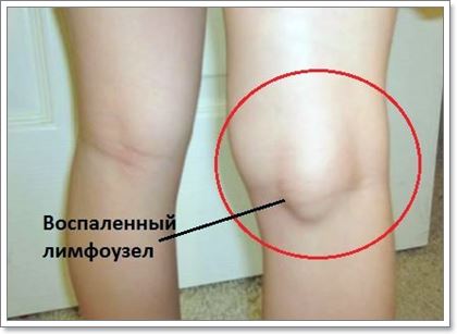 Воспаление лимфоузлов на ногах: виды болезни и способы лечения