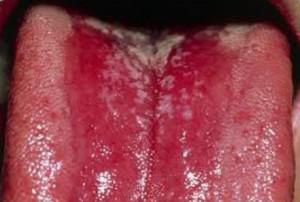 Кандидоз в ротовой полости: симптомы грибка во рту у взрослых, лечение белого налета препаратами и диетой