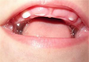 У ребенка в 5 лет вылез зуб моляр thumbnail