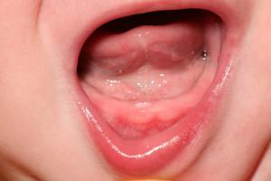 Воспаление десен у маленьких детей с фото: что делать, если слизистая опухла и покраснела?