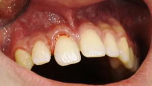 Сколько и как лечат полный вывих молочных или коренных зубов: этапы, особенности, фото