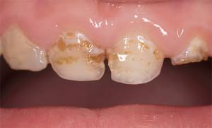 Что нужно делать, если у детей болят молочные зубы и появился кариес: как лечить и можно ли ставить пломбы?