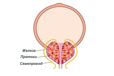 Кальцинат на клапане сердца