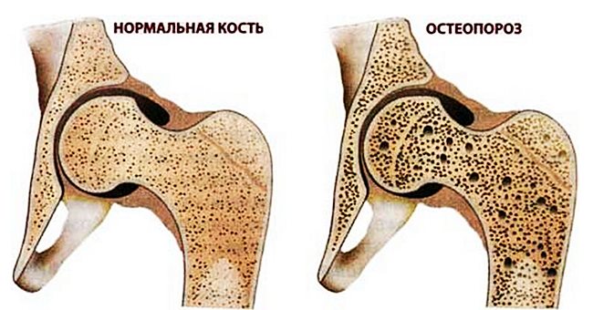 Остеопороз? Лечитесь питанием!