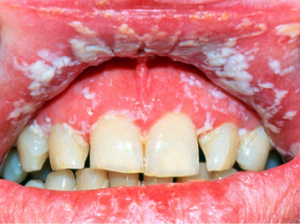 Как проявляется ВИЧ-инфицирование в полости рта фото язв и налета на языке