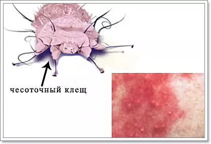Виды чесотки у человека фото