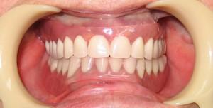 Зубные протезы к чему снятся thumbnail