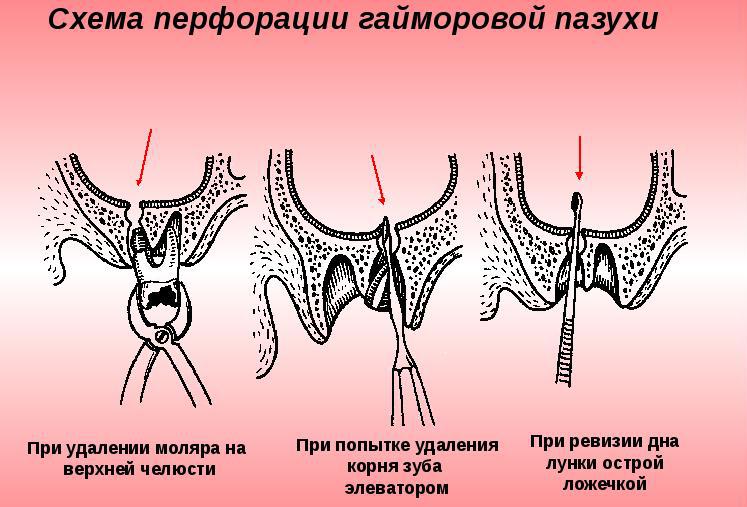 Ошибка 1704 при удалении касперского