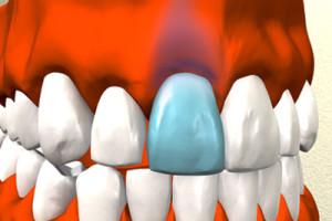 Симптомы и особенности лечения ушиба зуба у ребенка, профилактика травм