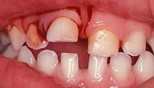 Сколько и как лечат полный вывих молочных или коренных зубов: этапы, особенности, фото