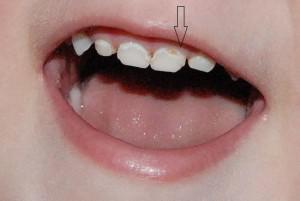 У ребенка 5 лет дырка в молочном зубе thumbnail