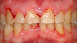 Полоскание рта корой дуба для избавления от зубной боли, при стоматите или флюсе
