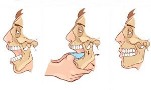 Вывих челюстного сустава операция thumbnail