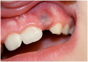 Почему у ребенка при прорезывании молочных зубов на десне возник синяк: причины гематомы